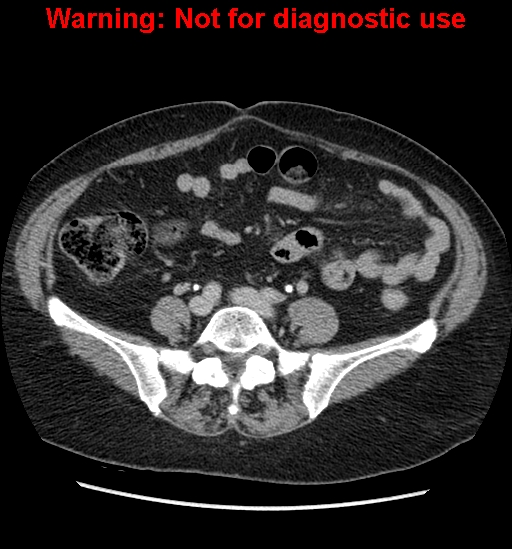 File:Bosniak renal cyst - type II (Radiopaedia 23404-23468 F 42).jpg