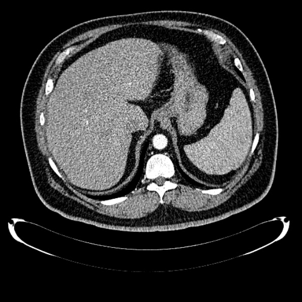 File:Bosniak renal cyst - type IV (Radiopaedia 24244-24518 B 57).jpg