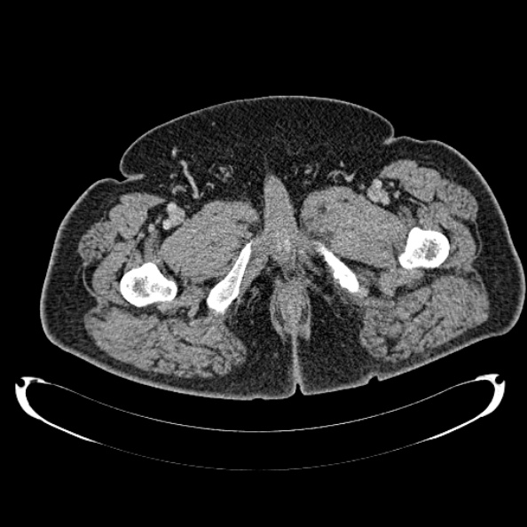 Bosniak renal cyst - type IV (Radiopaedia 24244-24518 C 341).jpg