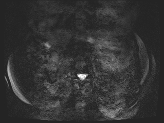 File:Bouveret syndrome (Radiopaedia 61017-68856 Axial MRCP 52).jpg