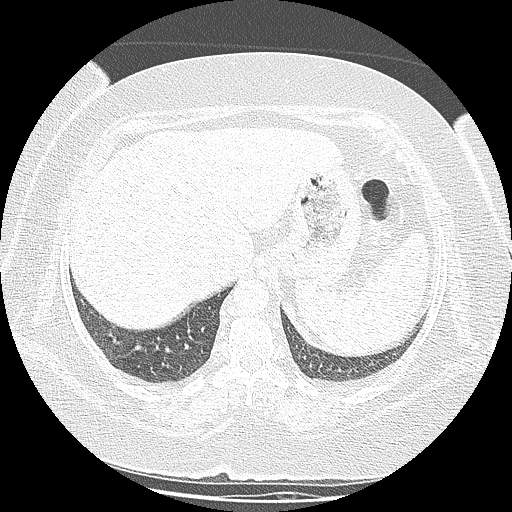 Bovine aortic arch - right internal mammary vein drains into the superior vena cava (Radiopaedia 63296-71875 Axial lung window 155).jpg
