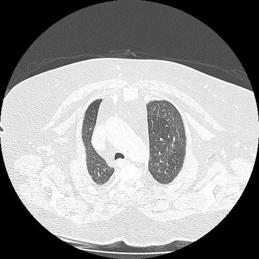 Bovine aortic arch - right internal mammary vein drains into the superior vena cava (Radiopaedia 63296-71875 Axial lung window 34).jpg