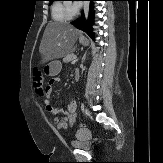 File:Bowel and splenic infarcts in acute lymphocytic leukemia (Radiopaedia 61055-68913 C 38).jpg