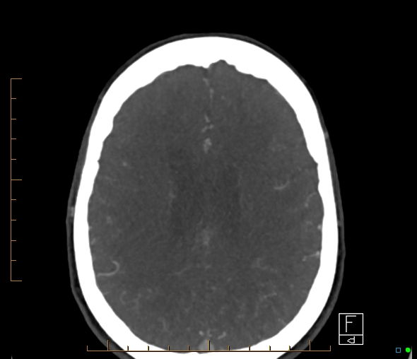 Brachiocephalic trunk stenosis (Radiopaedia 87242-103519 A 23).jpg