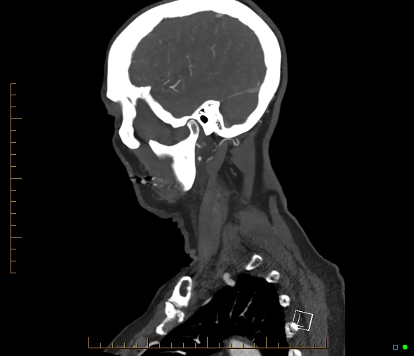 Brachiocephalic trunk stenosis (Radiopaedia 87242-103519 C 13).jpg