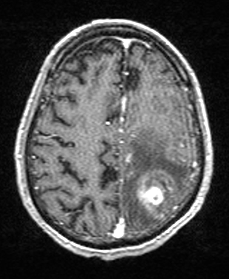 Brain abscess with dual rim sign (Radiopaedia 87566-103938 Axial T1 C+ 121).jpg