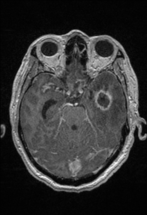 Brain abscess with ventriculitis (Radiopaedia 85703-101495 Axial T1 C+ 67).jpg