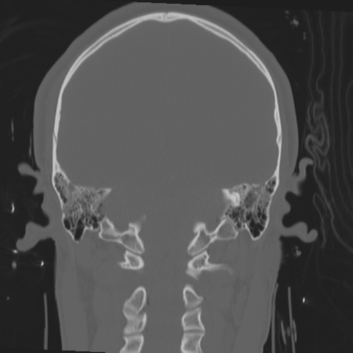 File:Brain contusions, internal carotid artery dissection and base of skull fracture (Radiopaedia 34089-35339 Coronal bone window 45).png