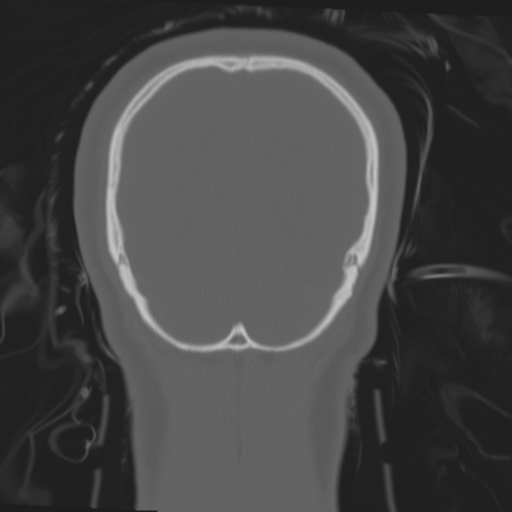 Brain contusions, internal carotid artery dissection and base of skull fracture (Radiopaedia 34089-35339 Coronal bone window 60).png