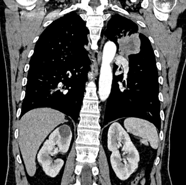 Brain metastases - lung cancer primary (Radiopaedia 75060-86116 C+ arterial phase 45).jpg