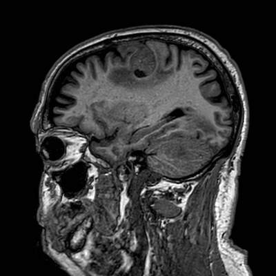 Brain metastases from lung cancer (Radiopaedia 83839-99028 Sagittal T1 91).jpg