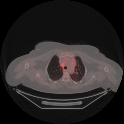 Brain metastasis (Radiopaedia 89847-106962 Axial lung window 12).jpg