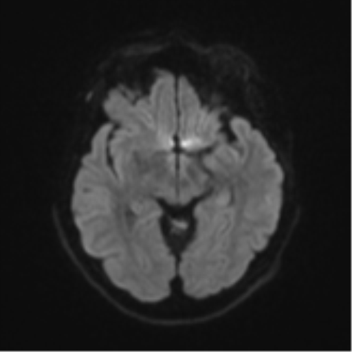 Brain metastasis (sarcoma) (Radiopaedia 47576-52209 Axial DWI 40).png
