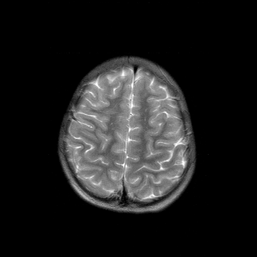 File:Brainstem ganglioglioma (Radiopaedia 10763-11224 Axial T2 4).jpg