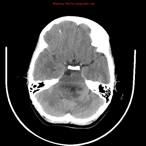 File:Brainstem glioma (Radiopaedia 9444-10123 non-contrast 5).jpg