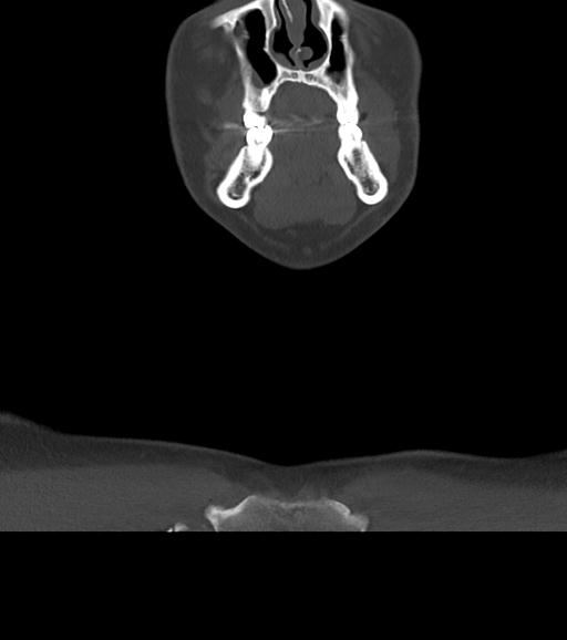 Branchial cleft cyst (Radiopaedia 31167-31875 Coronal bone window 15).jpg