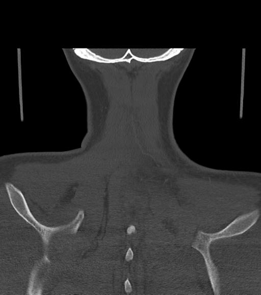 Branchial cleft cyst (Radiopaedia 31167-31875 Coronal bone window 59).jpg