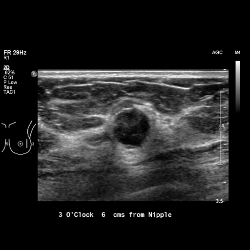 File:Breast metastases from renal cell cancer (Radiopaedia 79220-92226 Left breast US 8).jpeg