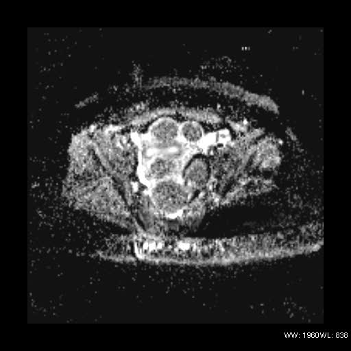 File:Broad ligament fibroid (Radiopaedia 49135-54241 Axial ADC 16).jpg