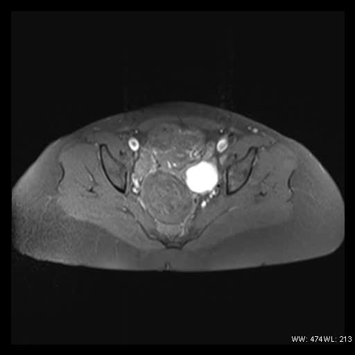 File:Broad ligament fibroid (Radiopaedia 49135-54241 Axial T1 fat sat 18).jpg