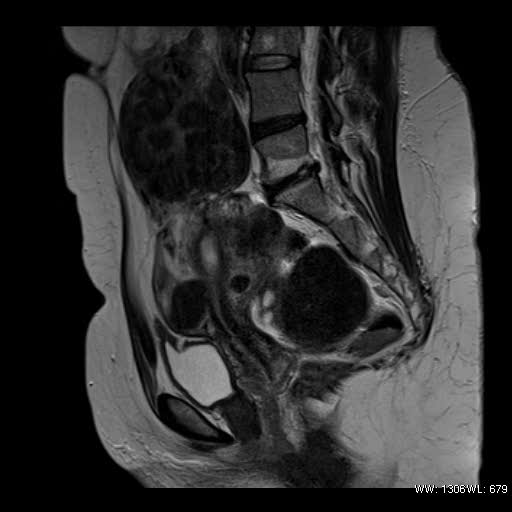 File:Broad ligament fibroid (Radiopaedia 49135-54241 Sagittal T2 15).jpg