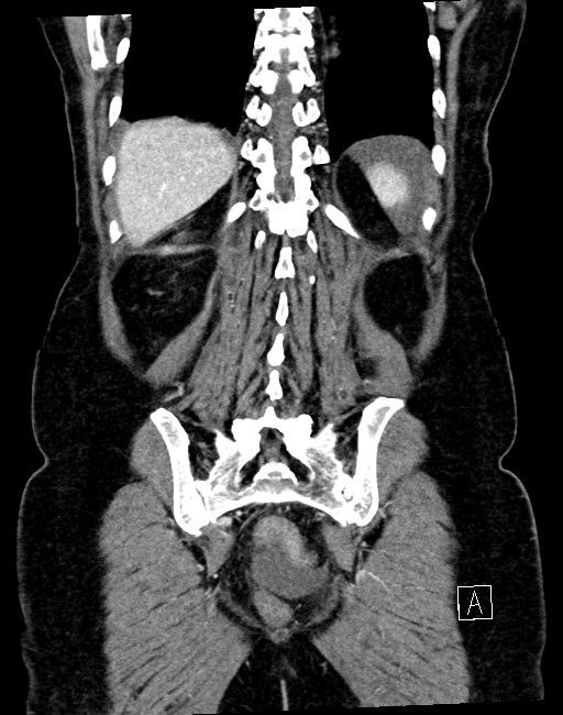 Broad ligament hernia (Radiopaedia 84802-100276 B 9).jpg