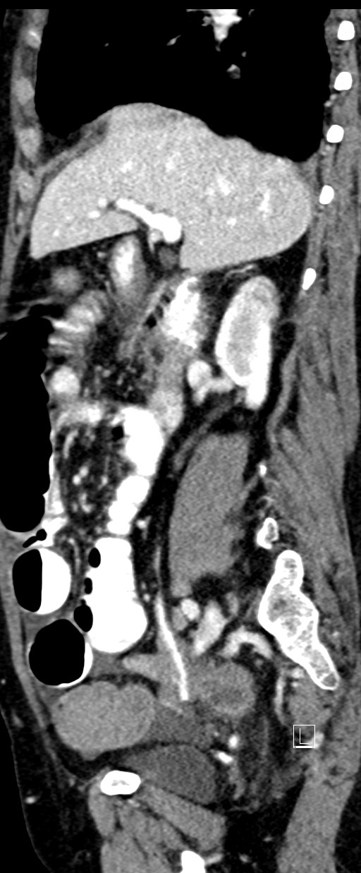 Broad ligament hernia (Radiopaedia 84802-100276 C 51).jpg