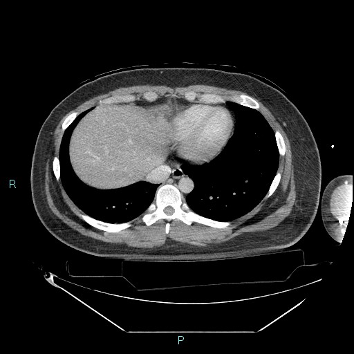 Bronchial carcinoid tumor (Radiopaedia 78272-90870 C 92).jpg