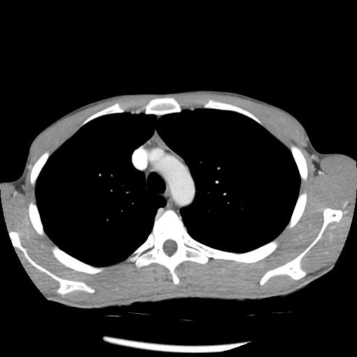 Bronchial carcinoid tumor causing right lower lobe collapse (Radiopaedia 83495-98594 A 12).jpg