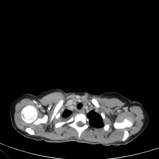Bronchial mucoepidermoid carcinoma (Radiopaedia 57023-63895 Axial 13).jpg