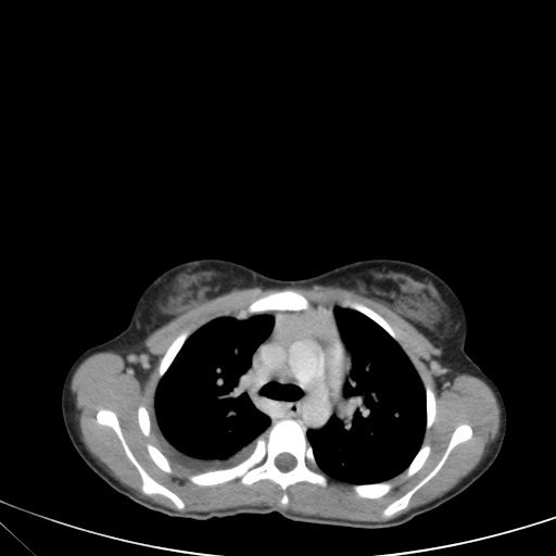 Bronchial mucoepidermoid carcinoma (Radiopaedia 57023-63895 Axial 35).jpg
