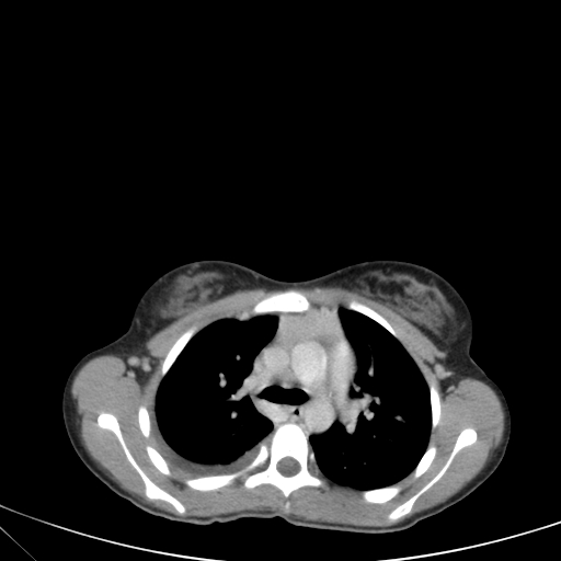 Bronchial mucoepidermoid carcinoma (Radiopaedia 57023-63895 Axial 36).jpg