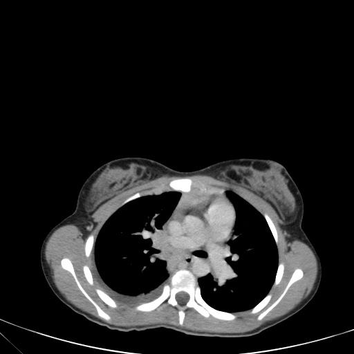 Bronchial mucoepidermoid carcinoma (Radiopaedia 57023-63895 Axial 45).jpg