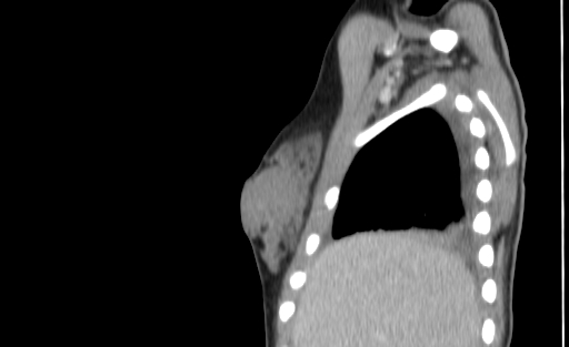 Bronchial mucoepidermoid carcinoma (Radiopaedia 57023-63895 Sagittal 2).jpg
