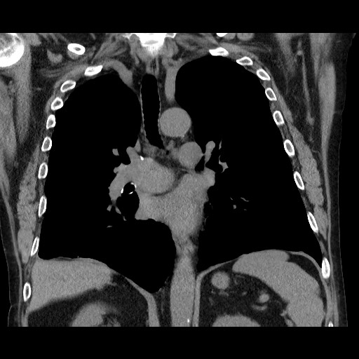 File:Bronchial stenosis - lung transplant (Radiopaedia 73133-83848 Coronal non-contrast 38).jpg