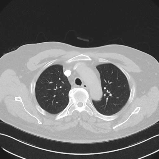 Bronchiectasis (Radiopaedia 39385-41666 Axial lung window 19).png