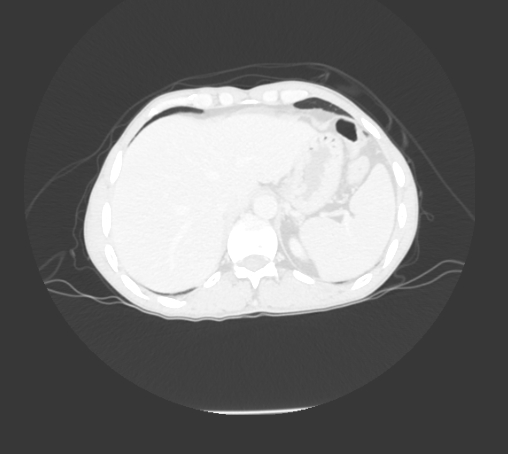 File:Bronchiectasis in Crohn disease (Radiopaedia 60311-67977 Axial lung window 33).jpg