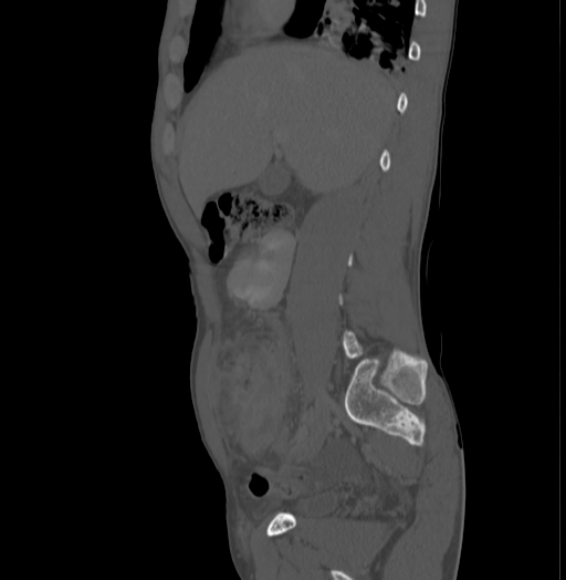 Bronchiectasis in Crohn disease (Radiopaedia 60311-67977 Sagittal bone window 73).jpg