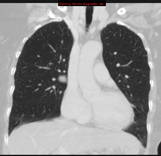 Bronchoalveolar carcinoma (BAC) (Radiopaedia 13436-13392 Coronal lung window 23).jpg