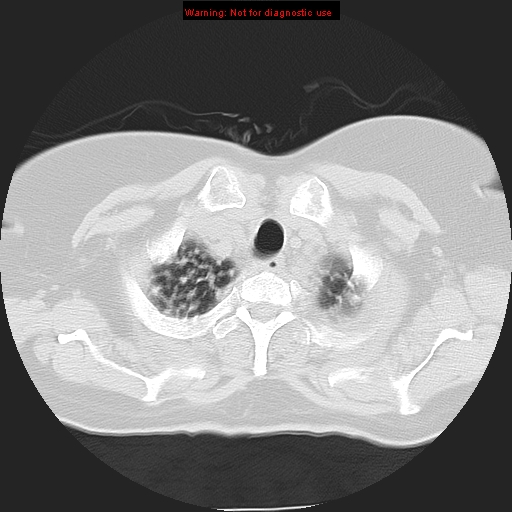 File:Bronchoalveolar carcinoma (Radiopaedia 13224-13233 Axial lung window 7).jpg