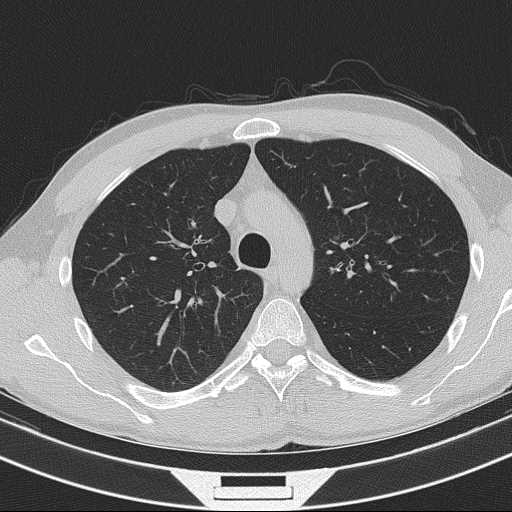 File:Bronchocele (Radiopaedia 60676-68429 Axial lung window 21).jpg