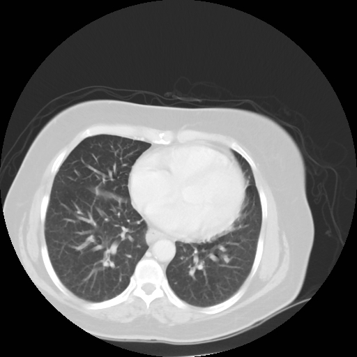 Bronchogenic carcinoma (Radiopaedia 73497-84262 Axial lung window 43).jpg