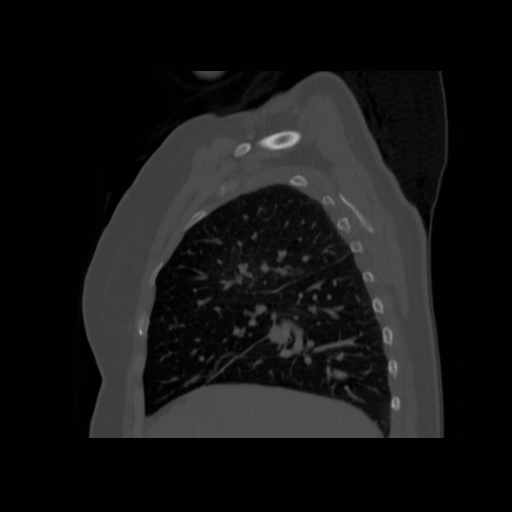 Bronchogenic carcinoma (Radiopaedia 73497-84262 Sagittal bone window 53).jpg