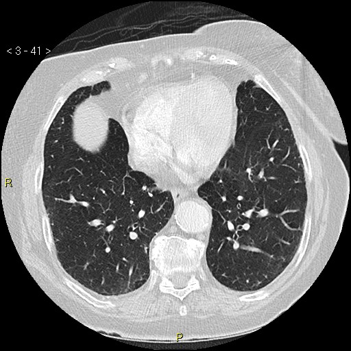 Bronchogenic carcinoma as an incidental finding (Radiopaedia 16453-16130 Axial lung window 41).jpg