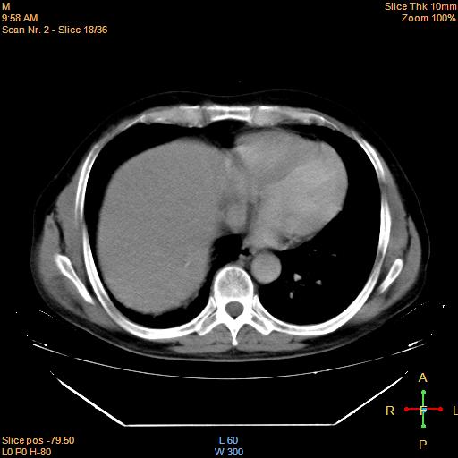 File:Bronchogenic carcinoma with superior vena caval invasion (Radiopaedia 22378-22406 Axial liver window 16).jpg