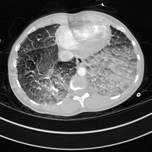 File:Bronchogenic cyst (Radiopaedia 77801-90071 Axial lung window 70).jpg
