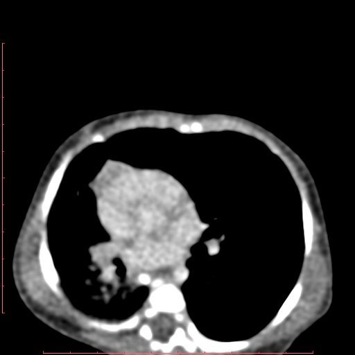 Bronchogenic cyst (Radiopaedia 78599-91409 B 107).jpg