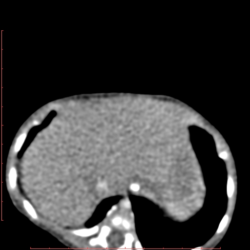 Bronchogenic cyst (Radiopaedia 78599-91409 B 170).jpg