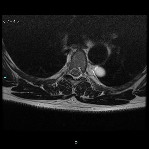 File:Bronchogenic cyst - posterior mediastinal (Radiopaedia 43885-47365 Axial T2 4).jpg