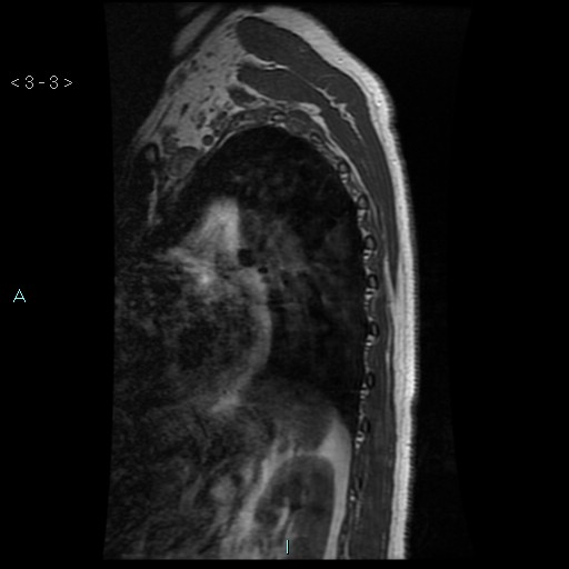 File:Bronchogenic cyst - posterior mediastinal (Radiopaedia 43885-47365 Sagittal T1 3).jpg